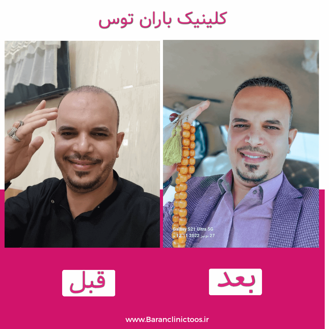 قبل و بعد کاشت مو